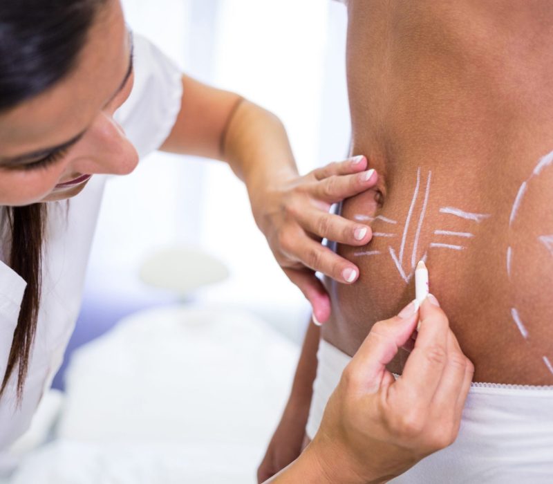 surgeon-drawing-lines-womans-abdomen-liposuction-cellulite-removal